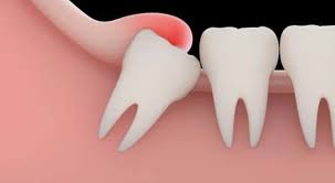 Wisdom Teeth Questions, Third Molar Problem Question and Frequently Asked Questions about Wisdom Tooth Problem